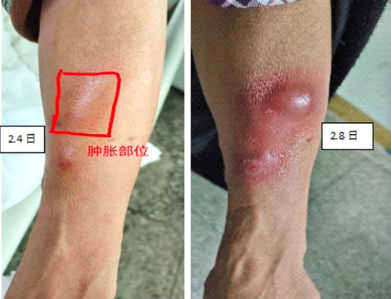 静脉留置针拔除后,前臂肿胀是为什么?