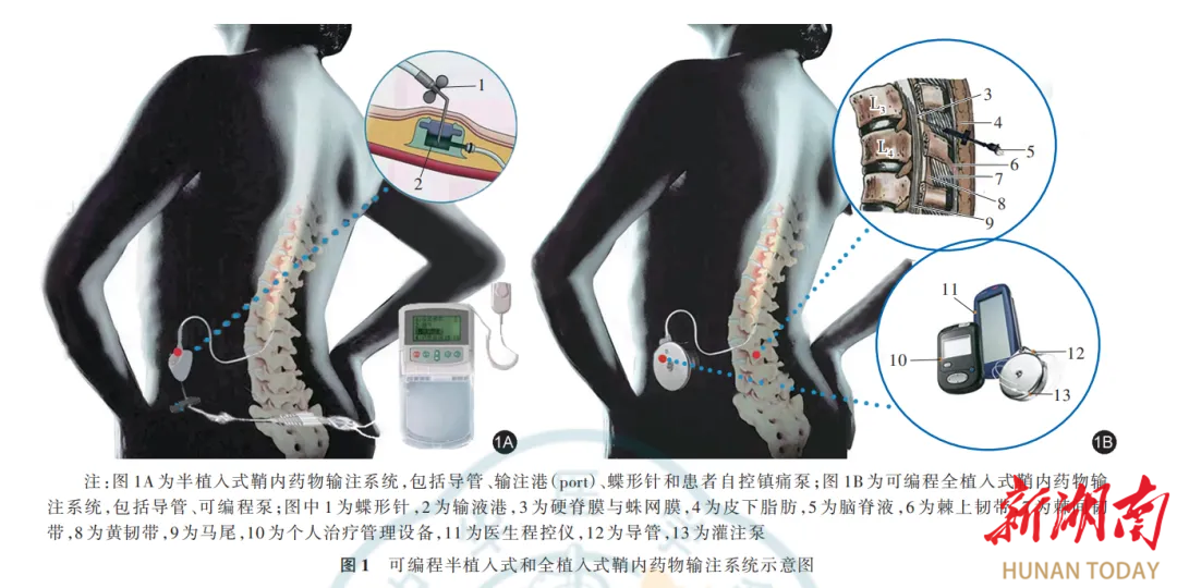 鞘内吗啡泵输注系统置入术:鞘内镇痛,为癌痛解忧