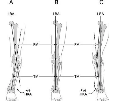 正常的下肢力线图片图片