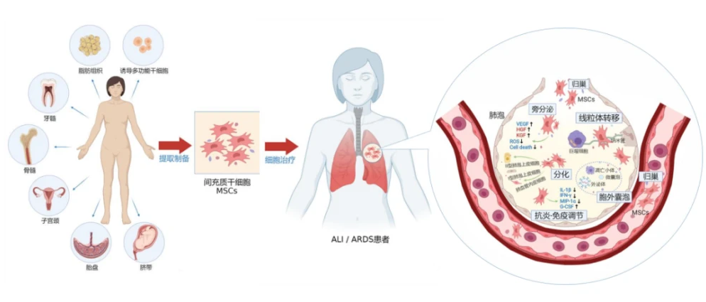 间充质干细胞治疗急性肺损伤和急性呼吸窘迫综合征