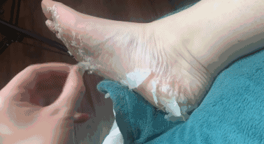 美女也会得脚气,究竟是怎么回事