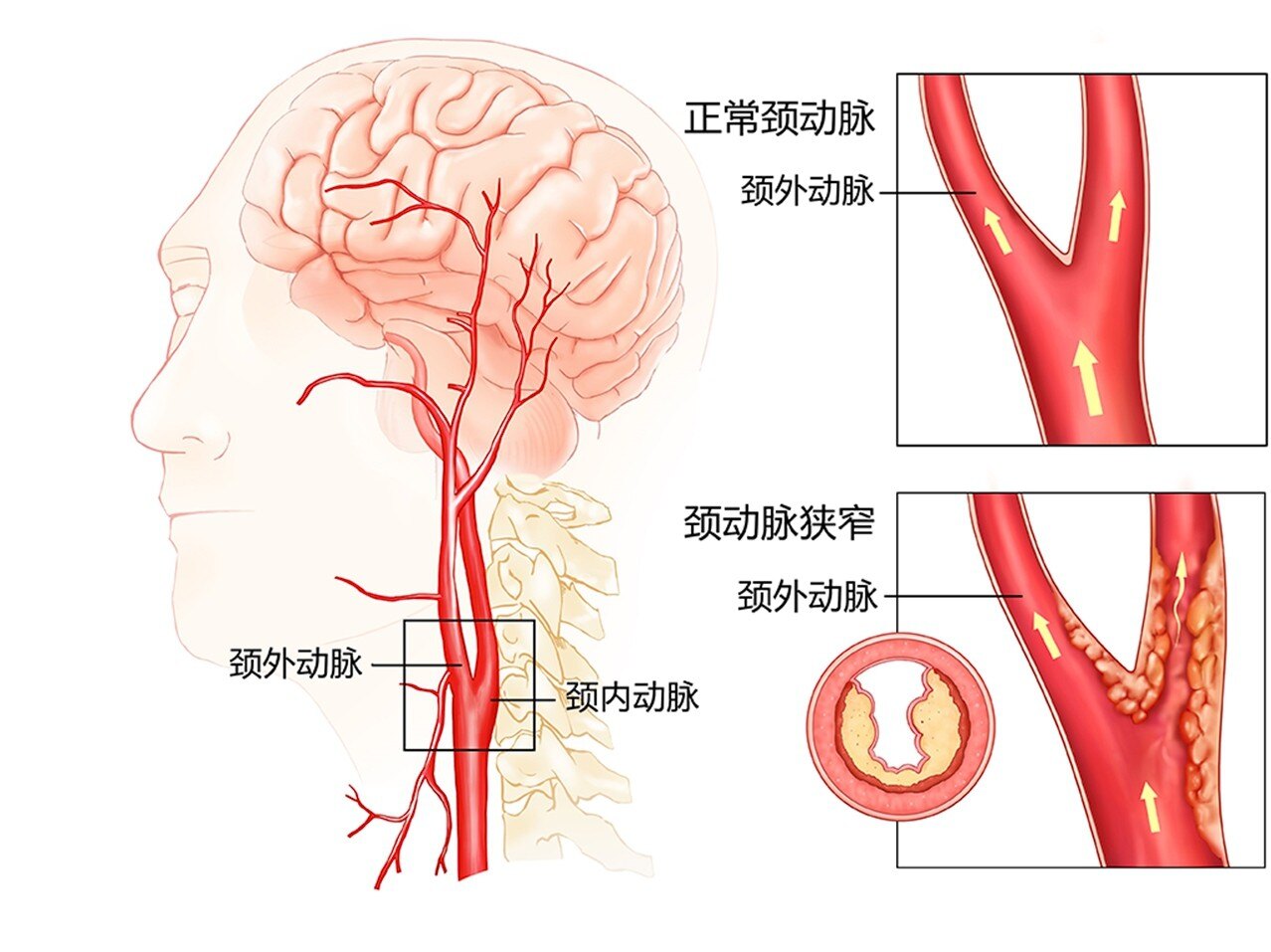 颈动脉的位置图片图片