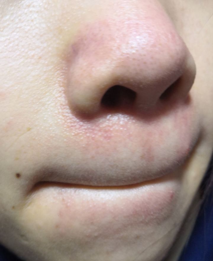 面部脂溢性皮炎初期图片