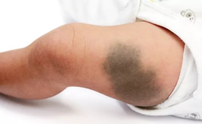 什么是色素性的胎记?