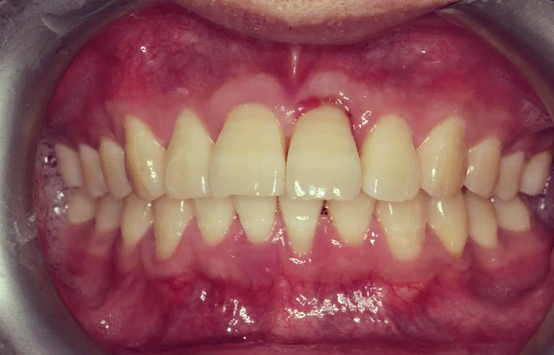 3度松动牙的治疗过程及长期效果观察