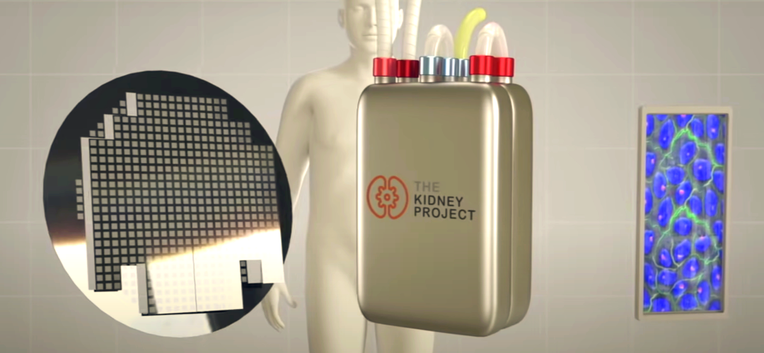 植入式人工肾:从实验室到临床的潜力与挑战