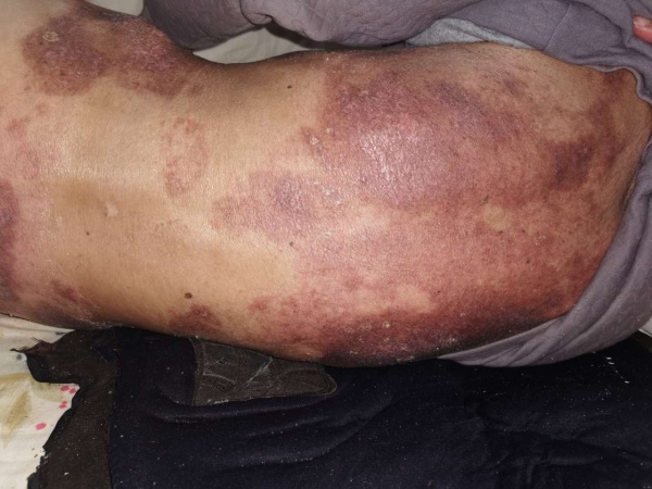 重病老人"全身脱皮"陷囹圄 皮肤专家"老药新用"解危机