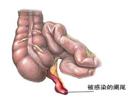 阑尾炎位置示意图图片