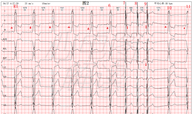 室性逸搏心律图片图片