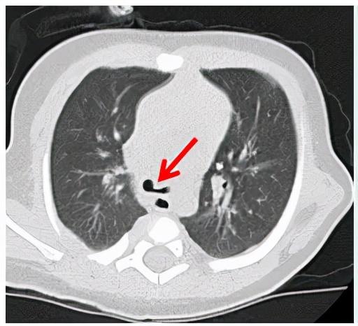 广州妇儿中心成功为3月龄"气管软化"宝宝实施胸腔镜下主动脉弓悬吊术