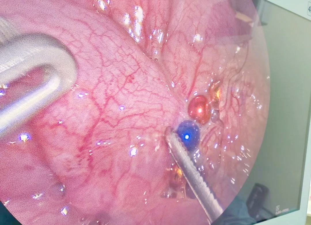 珠子吞下去了会拉出来吗_吞了一个珠子（珠子吞进肚子怎么办）