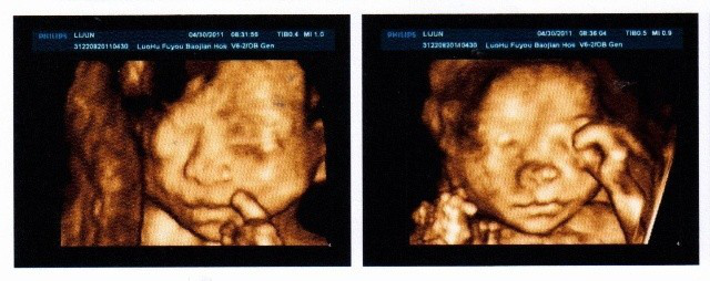 准妈妈被宝宝四维彩超丑哭,四维就是娃的长相吗?网友:还有救