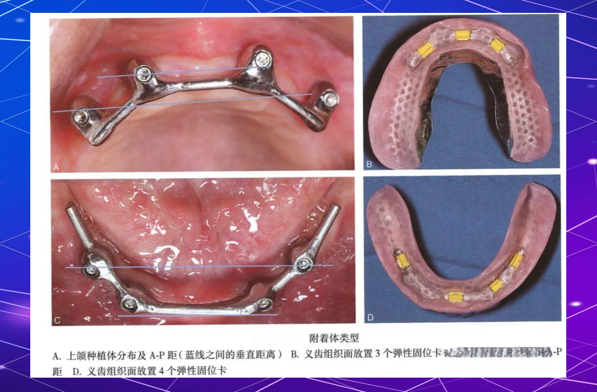 种植覆盖义齿中的locator基台与杆卡附着体解析