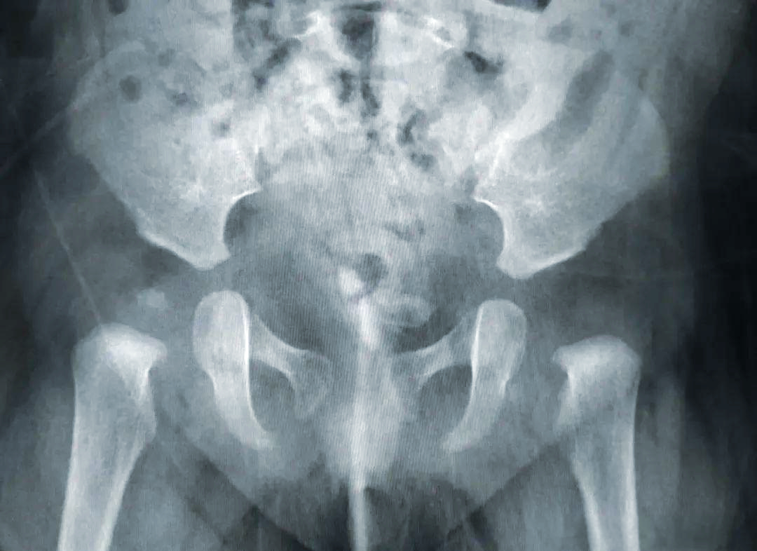 先天性髋关节脱位的预防,诊断与治疗策略