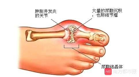 數十年來海鮮當飯,六旬老伯手,足關節長出數百顆痛風石