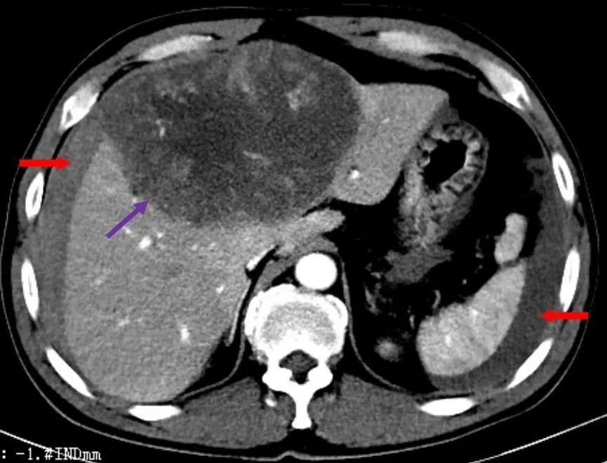 肝癌ct图片怎么看图片