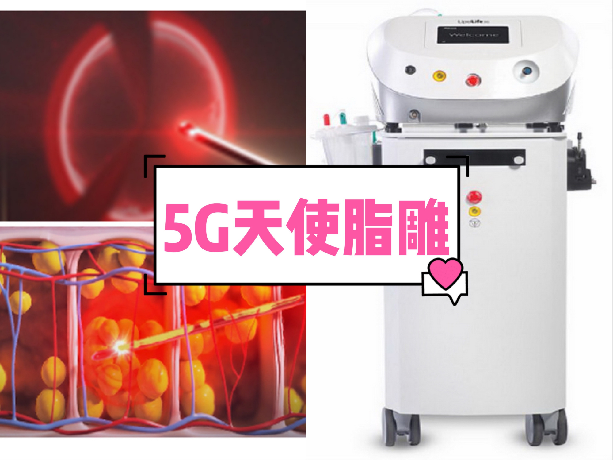 水动力,5g天使脂雕,宝丽太,该如何选择吸脂仪器?