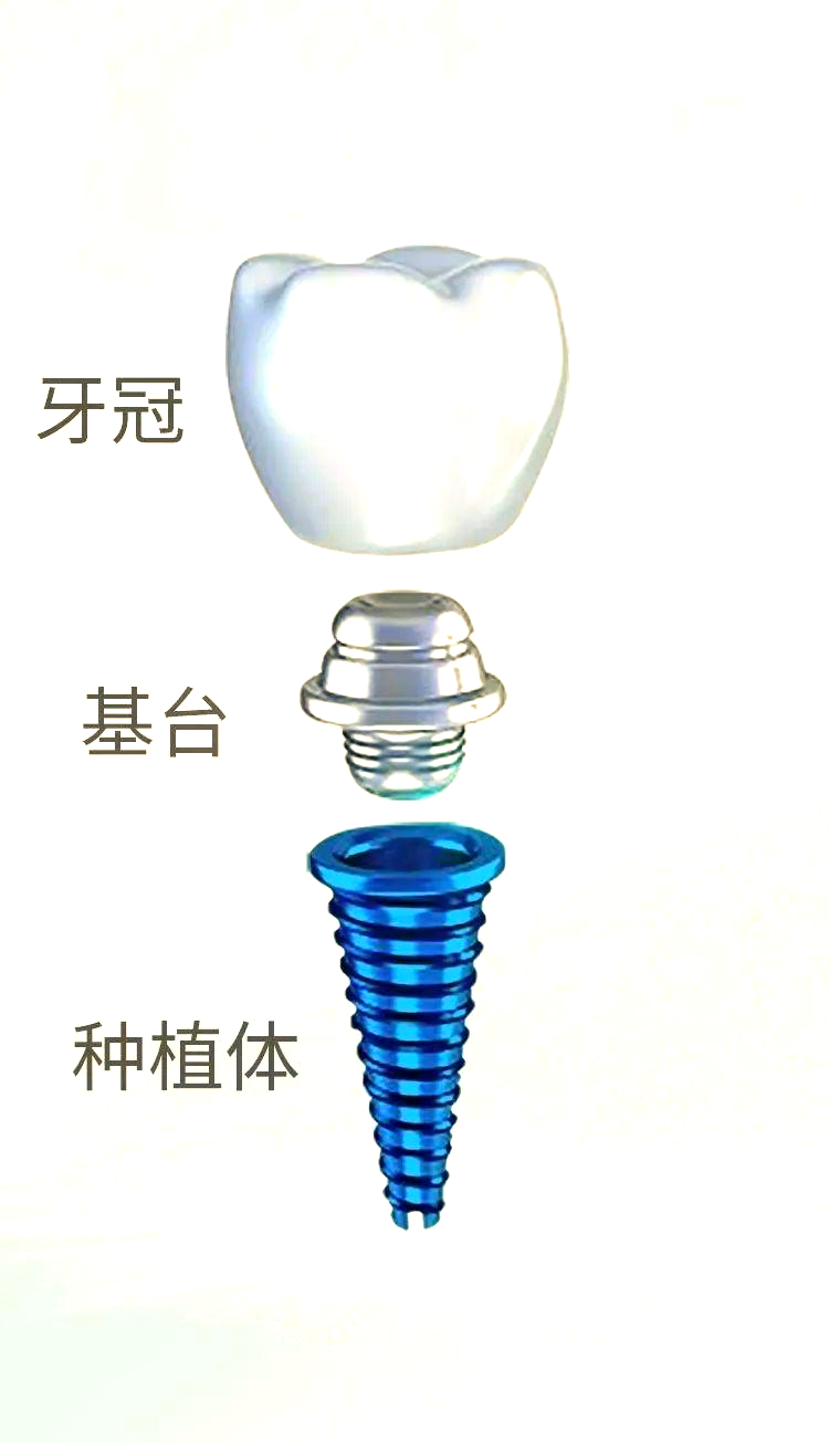 种植牙基台的种类与选择指南