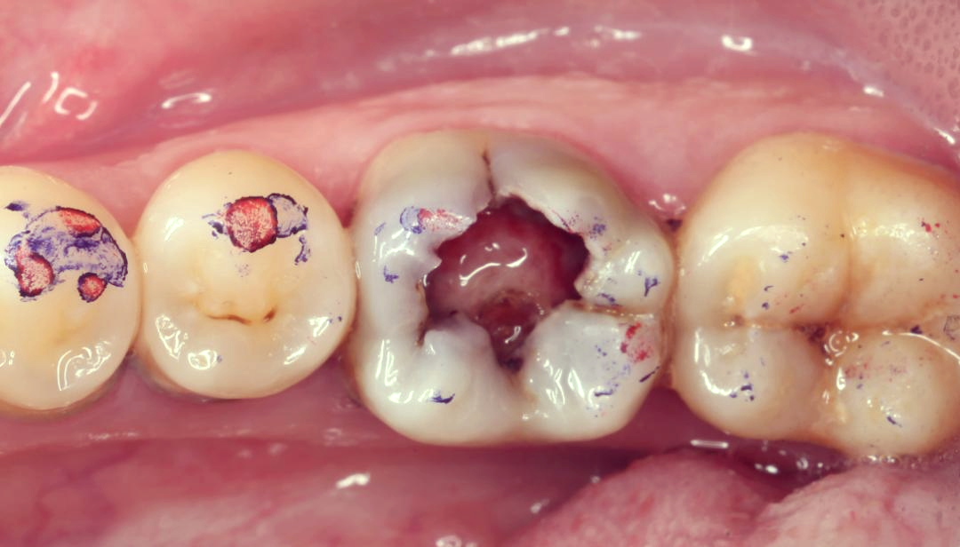 图1 术前照x光片显示患牙龋坏严重,髓腔扩大,牙周膜增宽