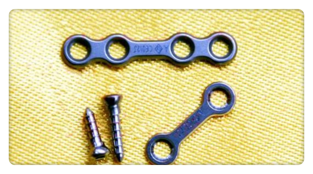 正颌手术用钛板钛钉固定安全吗?