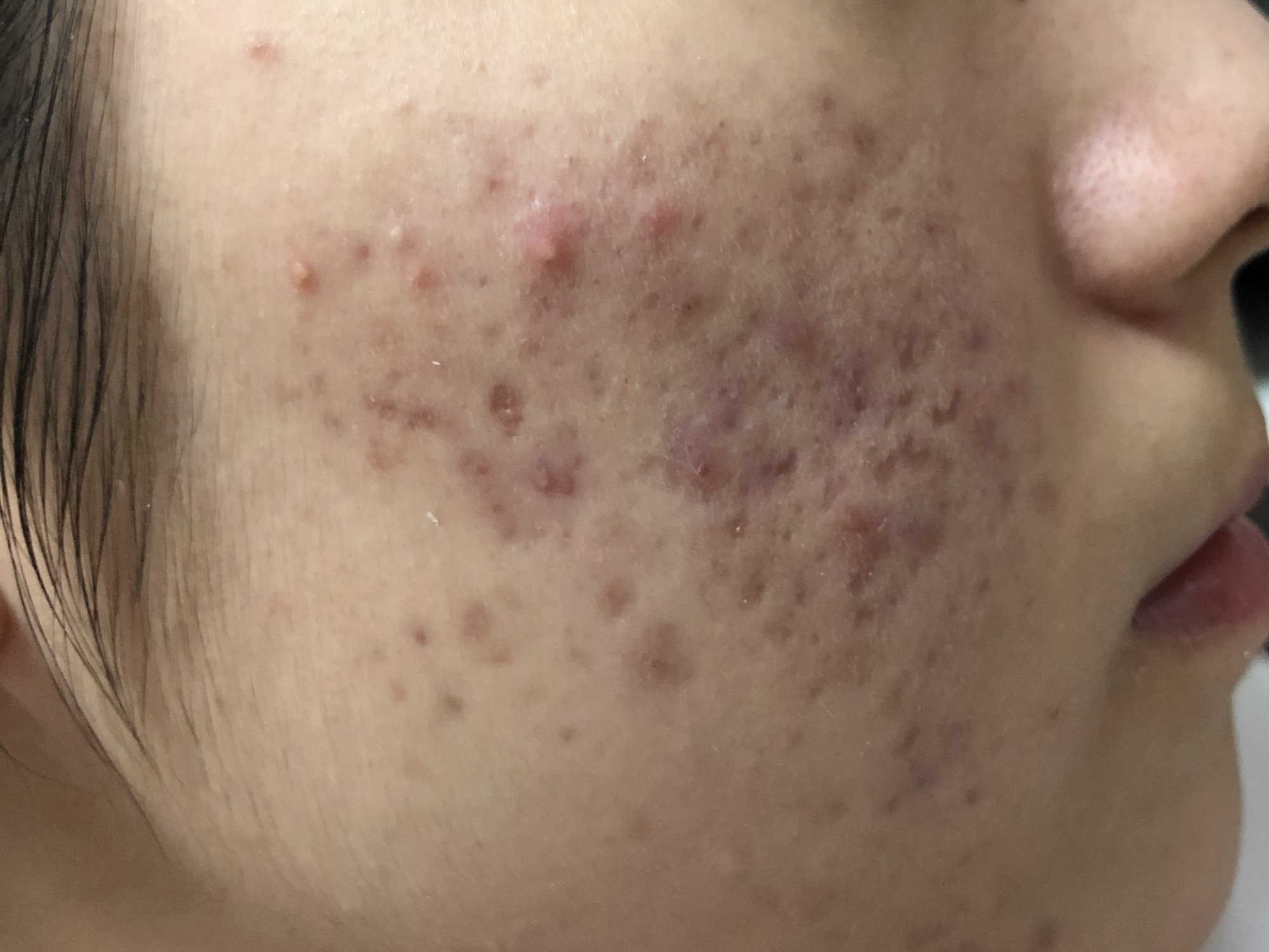 17岁女儿脸上长满痘痘,看了这篇文章才知道如何帮助她