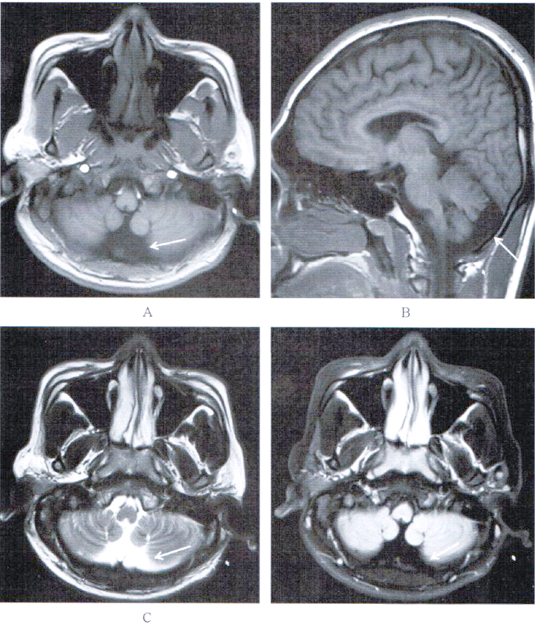 大枕大池及其鉴别诊断详解