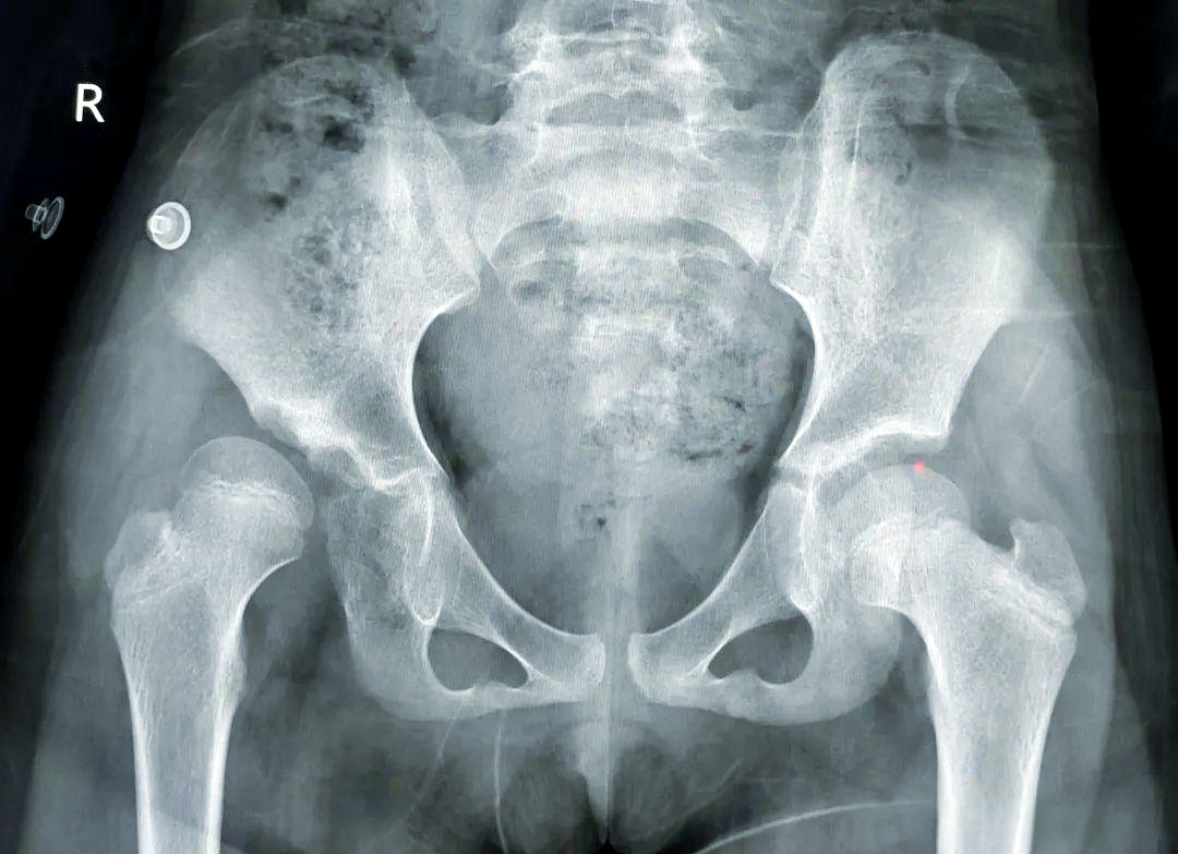 先天性髋关节脱位的预防,诊断与治疗策略