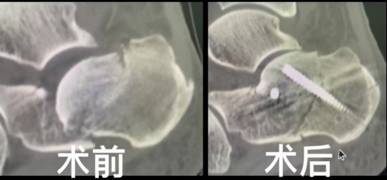 切口僅1釐米,螺釘固定精準到亞毫米級!關節鏡機器人齊齊助力骨折手術