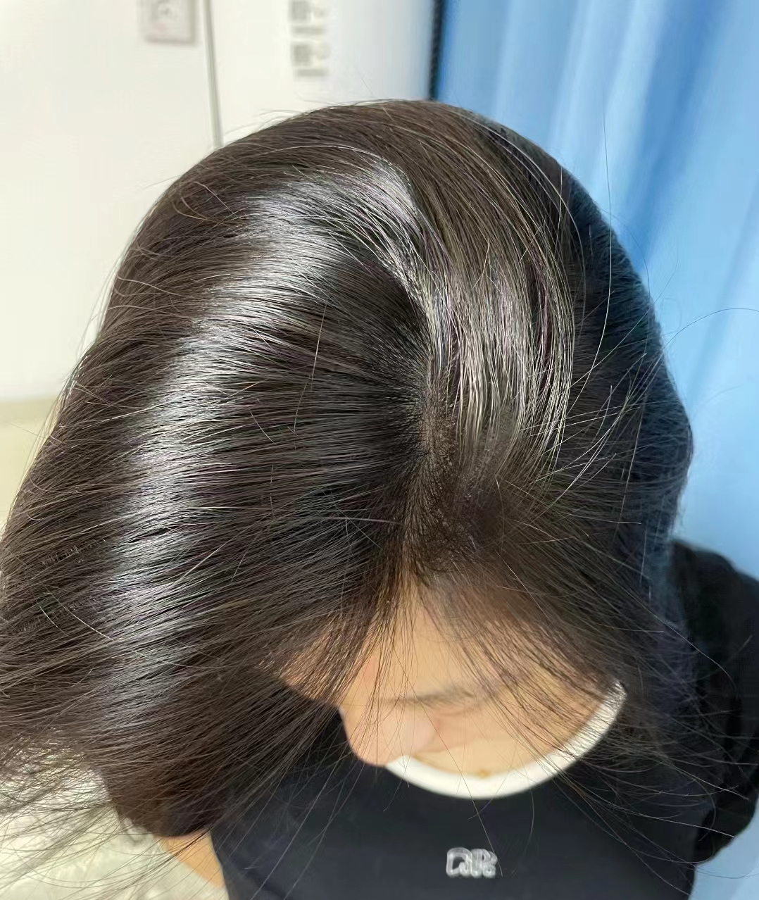 掉发严重发缝大怎么办?牢记这两个方法,让你重新长出浓密秀发!
