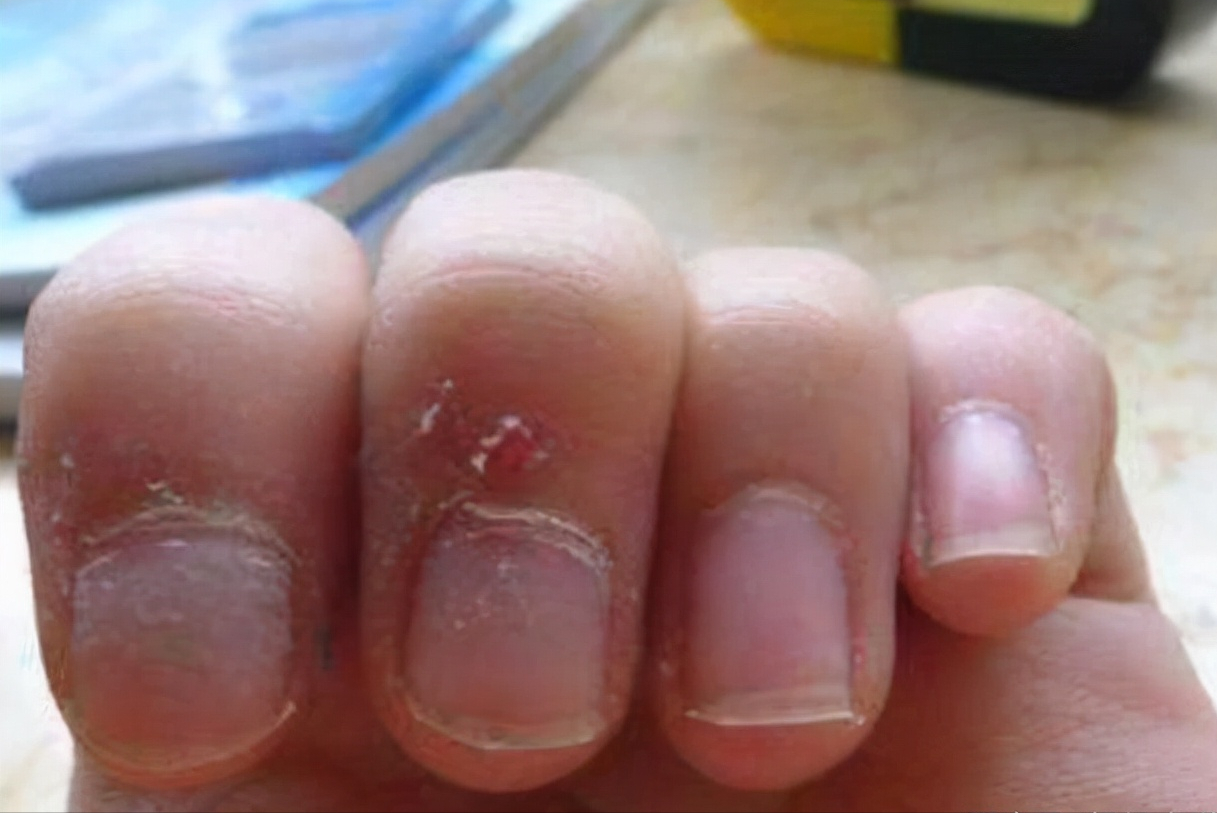 孩子手上长"倒刺",暗示着娃可能正经历"隐性饥饿",要重视