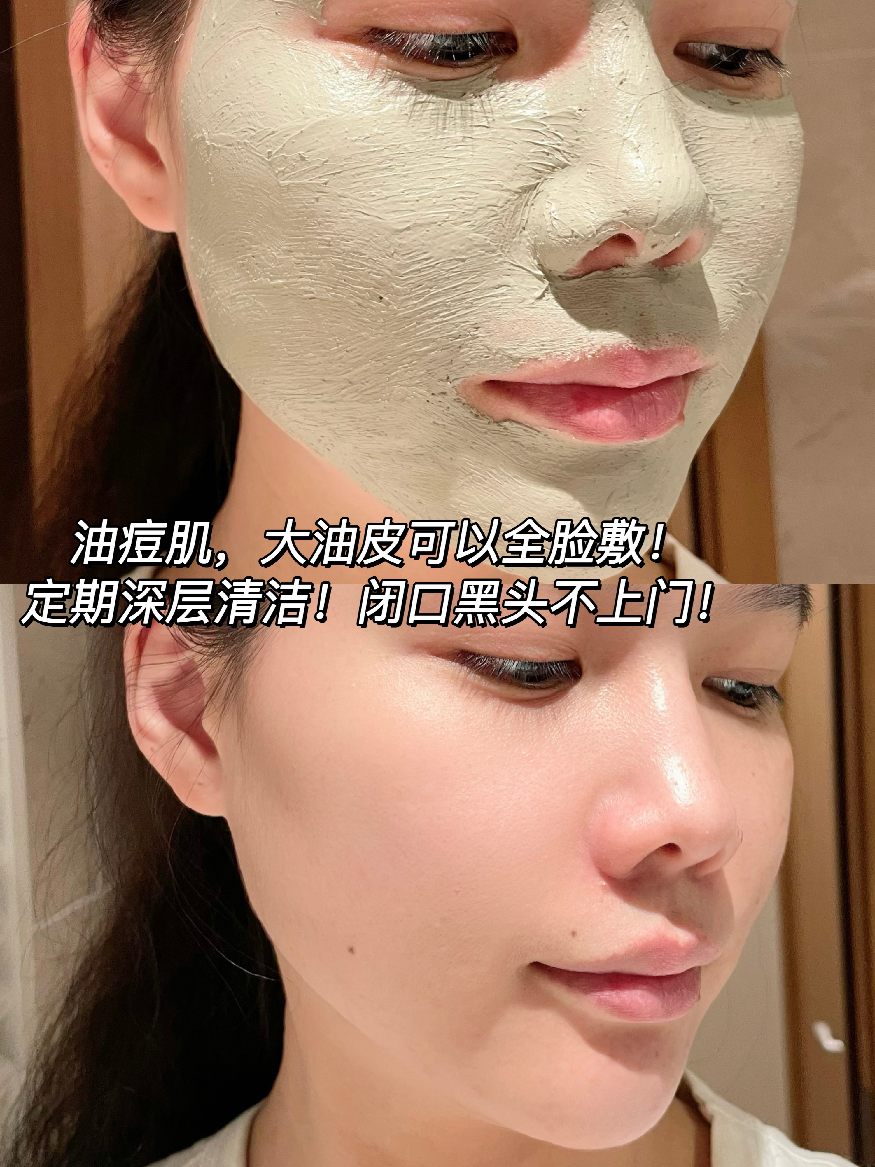闭口黑头脸拿捏用了自然堂茶泥膜下巴真的好光滑