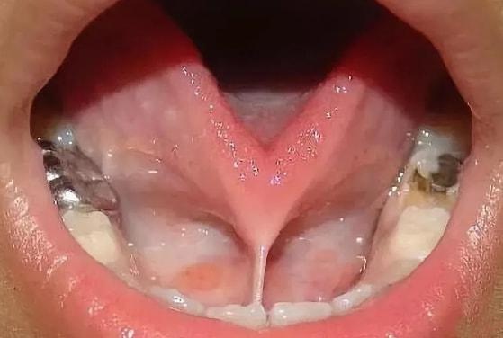 舌头形状不对,奶奶瞒着家人给娃剪舌根!