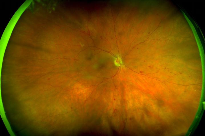 免散瞳,超广角,欧堡带你去看不一样的眼底!