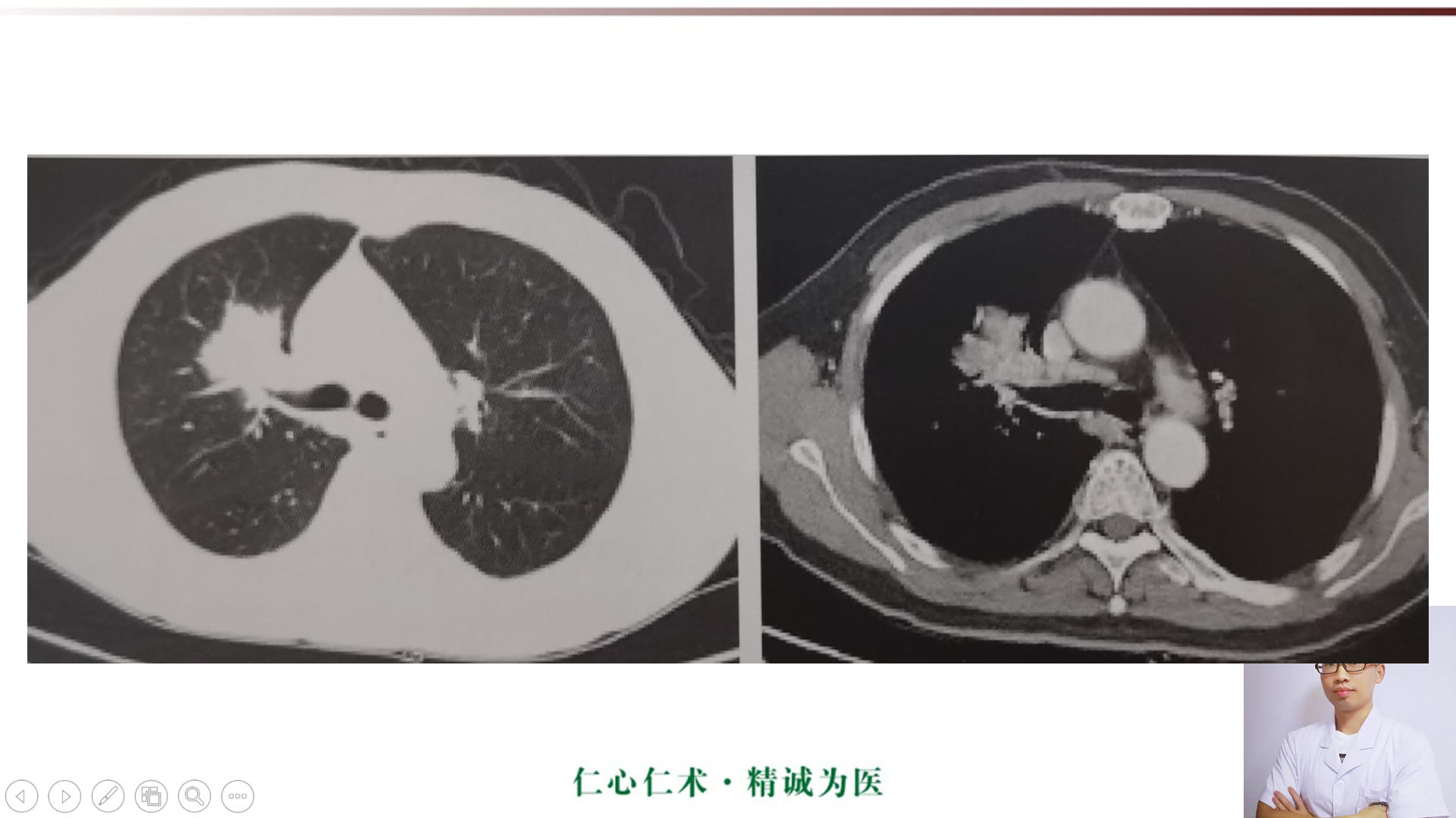 影像基础知识:中央型肺癌ct表现及报告书写!