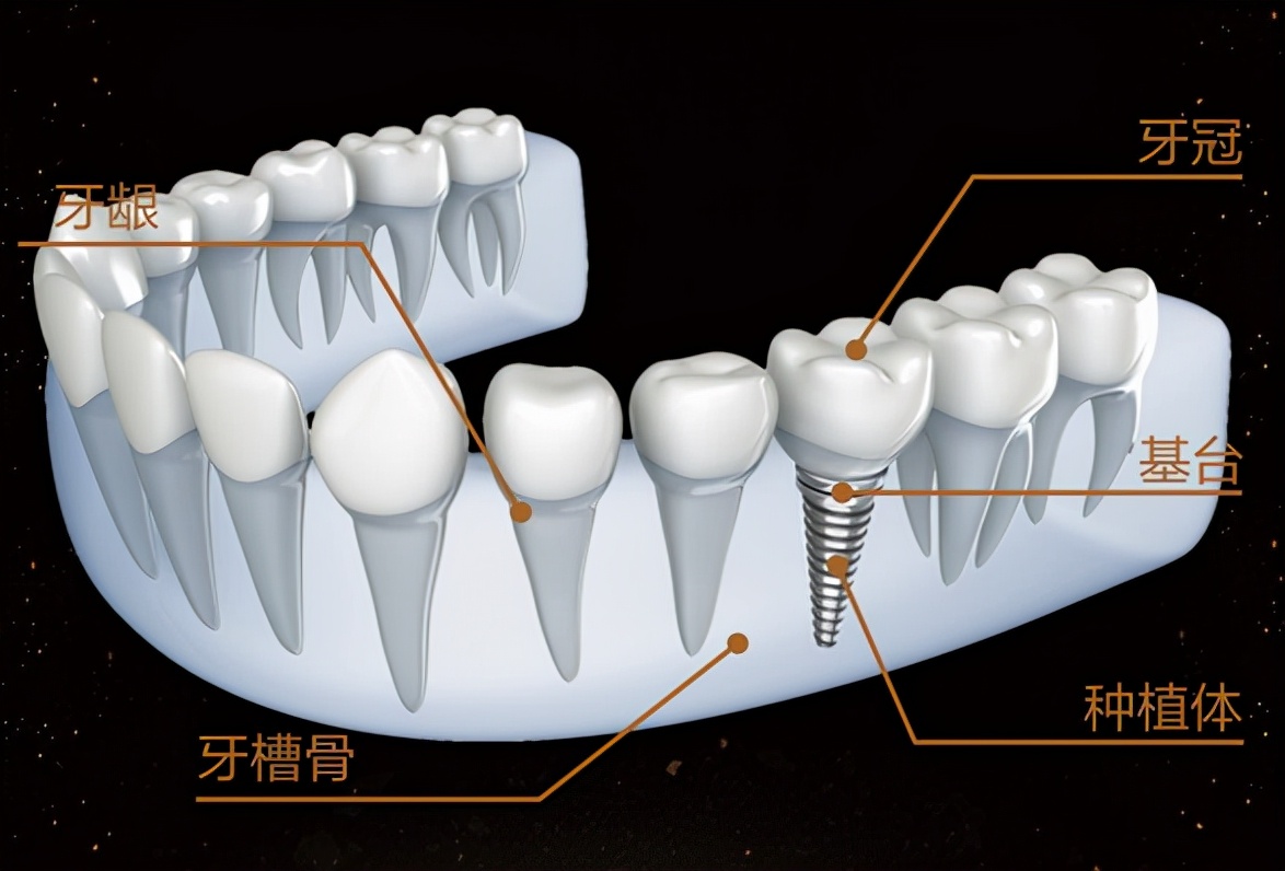 种植牙一直在牙槽骨里面,会导致牙骨坏死吗?