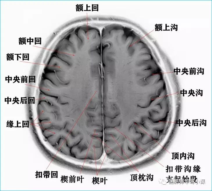 侧隐窝mri示意图图片