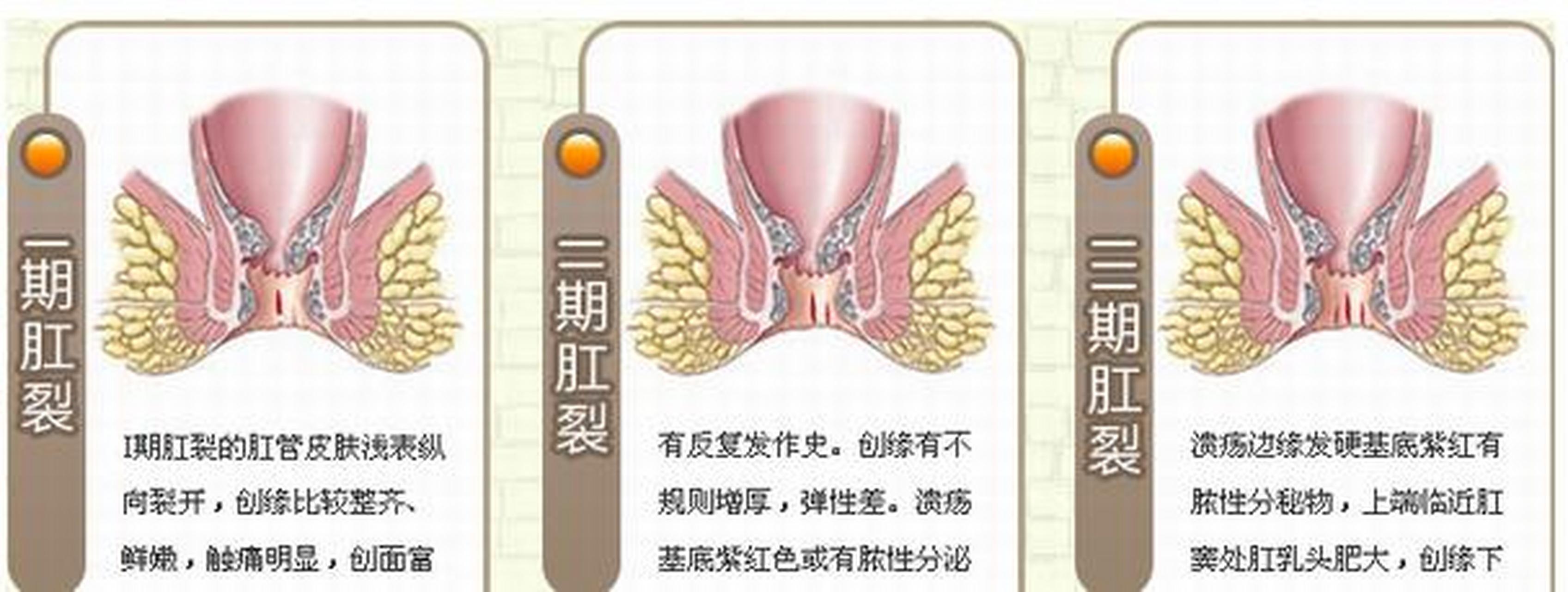 肛裂赘生物图片图片