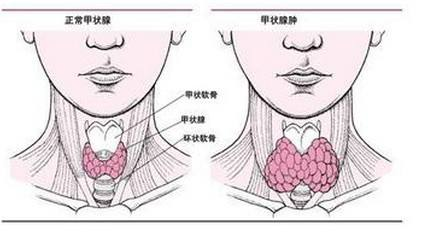 甲状腺ai早期的五大症状,早发现早治疗!