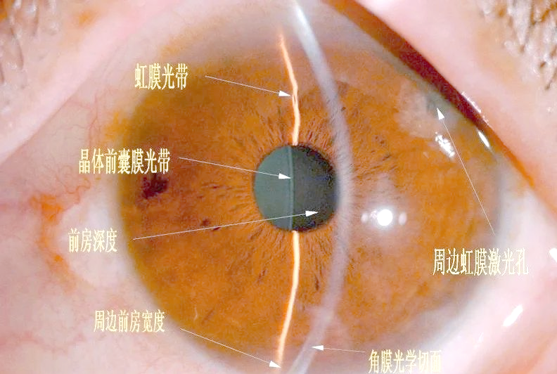 裂隙灯的多种照明方法介绍