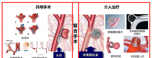 脑动脉瘤介入治疗图解图片