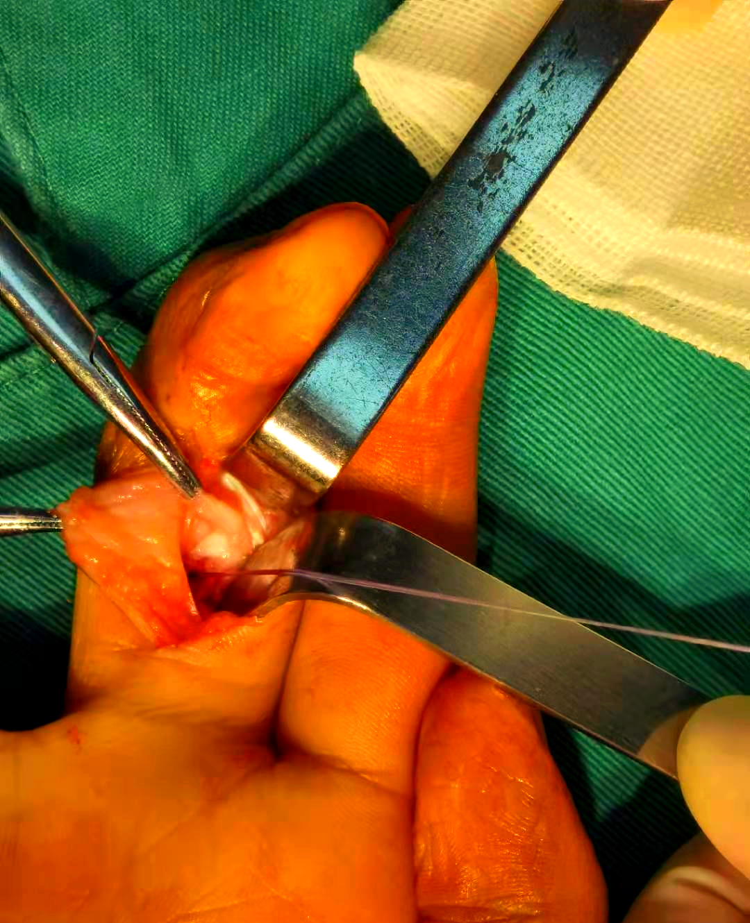 手部鹅颈畸形,成功矫正为患儿带来新希望