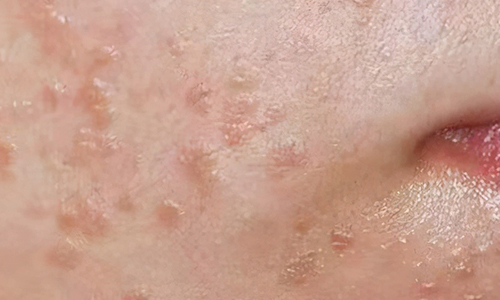 会"伪装"的扁平疣,一文区分扁平疣和粉刺