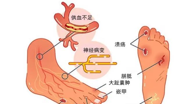 糖尿病并发周围血管病变,会出现哪些症状,需要做哪些检查