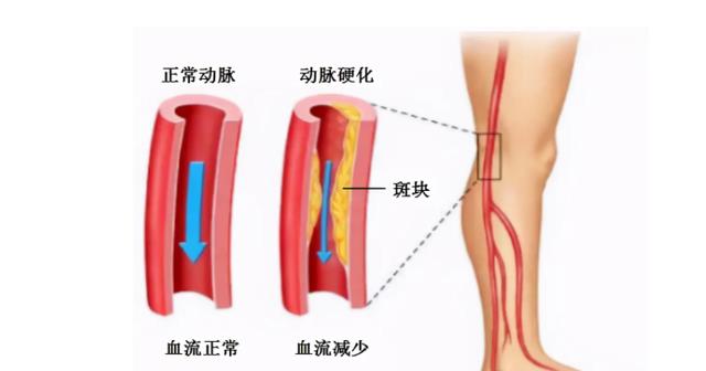 糖尿病并发周围血管病变,会出现哪些症状,需要做哪些检查