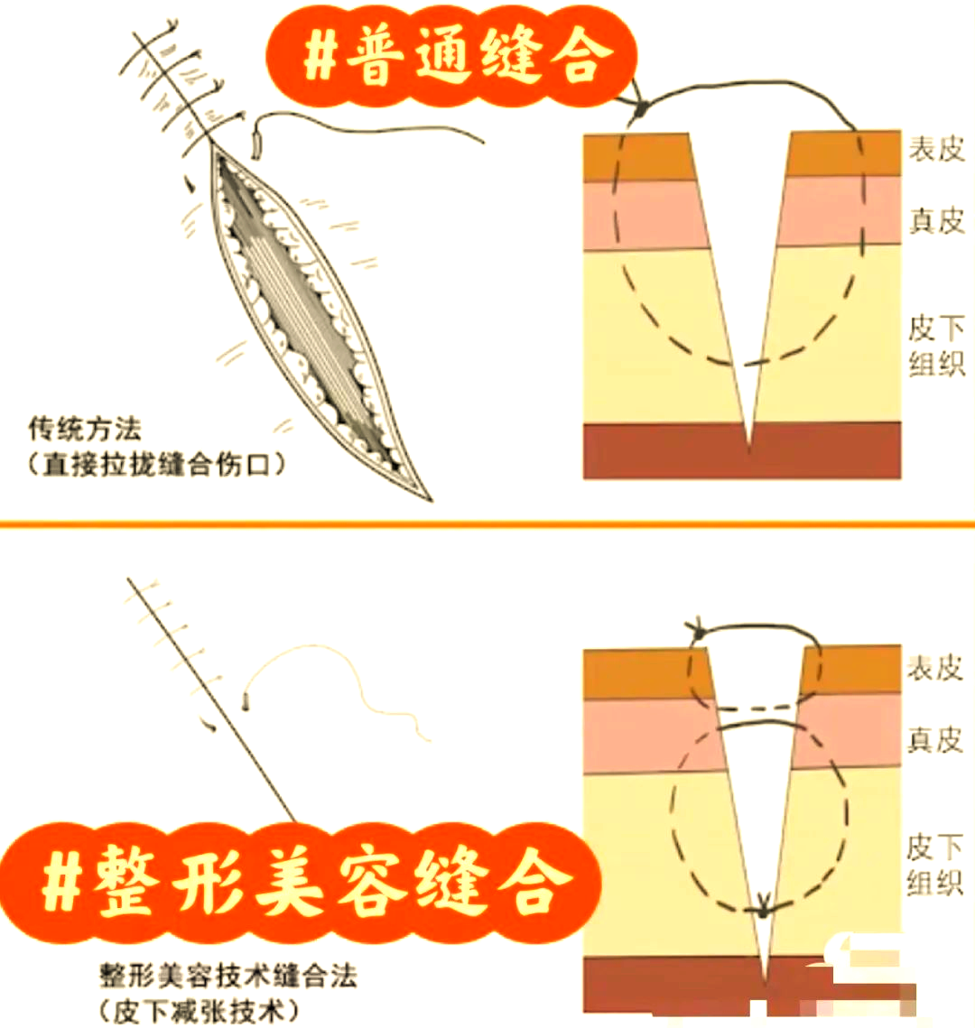 多种美容缝合技术助力伤口愈合美观
