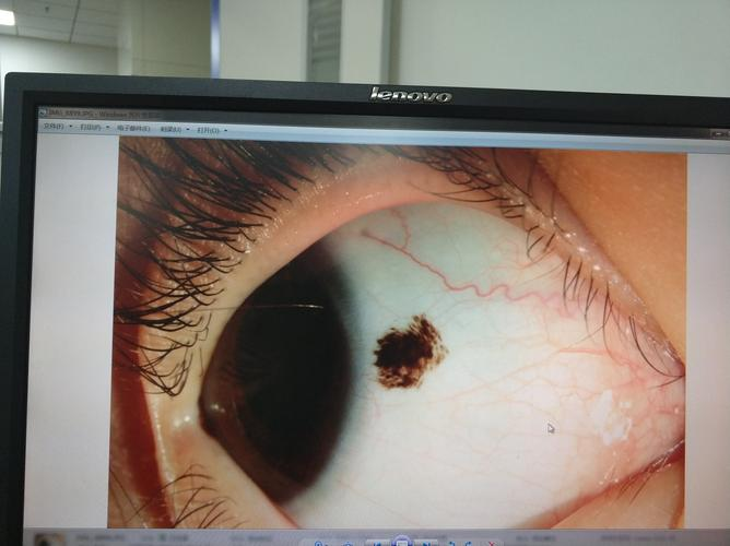 眼球黑点鉴识:从担忧到安心的治疗过程