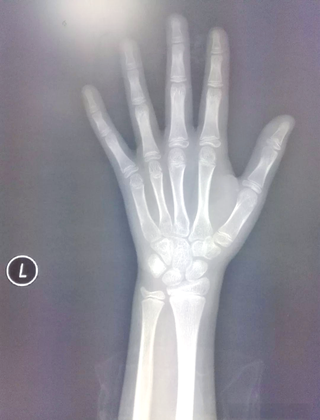 阅片显示,患者左腕骨已出现8块,形态成熟,同时尺桡骨,掌指骨骨骺状态