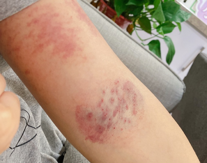 30岁奥运冠军何姿近况:放血扎针缓解伤病,生娃后颜值逆生长