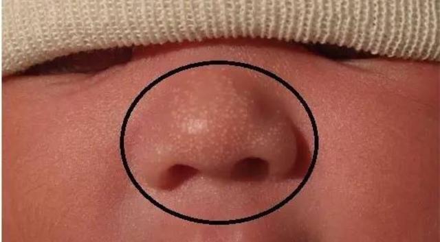 婴儿鼻子上有小白点能用手挤吗(婴儿鼻子上的白点可以不管吗)