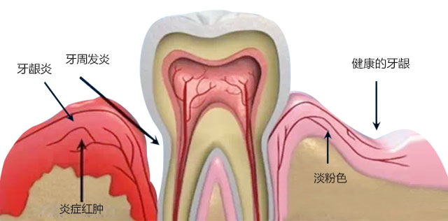 牙周炎图片大全图片